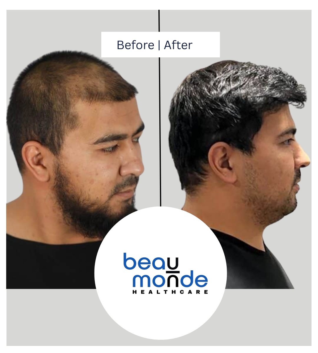 hair transplant cost